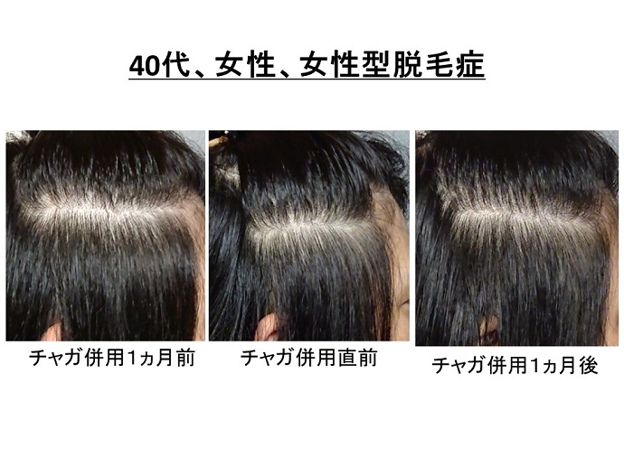 円形脱毛症　病院